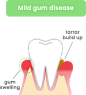 Mild gum disease