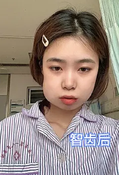 #拔智齿前后的脸型变化# 

哈哈哈哈哈哈哈哈哈哈哈哈哈
拔完智齿真的会这么肿吗 ​​​​
