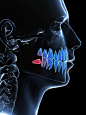 Impacted wisdom teeth  - Novan Dental - Your Sacramento, Greenhaven and Pocket Area's Premier Dentist : impacted wisdom teeth