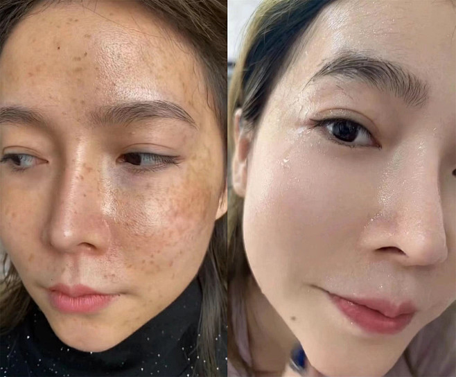 为什么我建议脸上有晒斑、黄褐斑的一定要用...