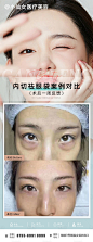 医美整形祛眼袋案例海报-源文件