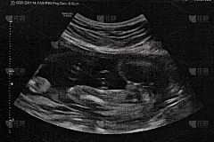 孕妇胎儿超声检查。