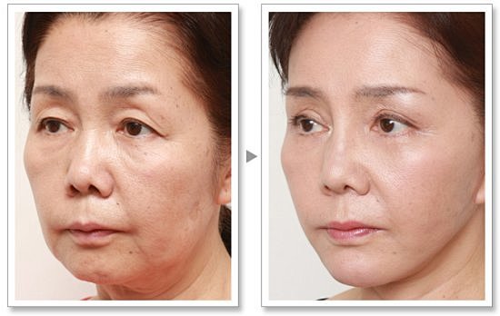 美贝尔面部提升术案例对比图