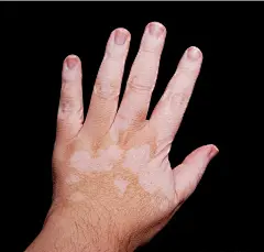 白癜风的搜索结果_360图片