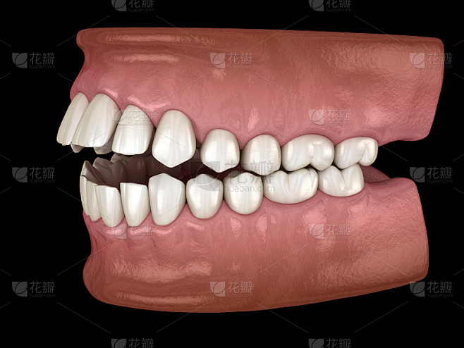 开齿咬合(牙错咬合)。医学上准确的牙齿3D插图