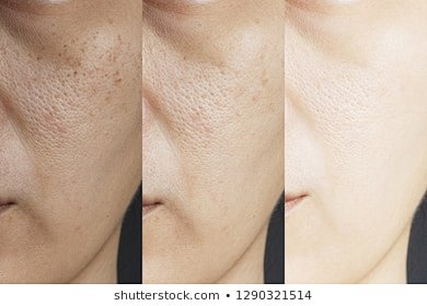 治疗前后三张照片比较效果。皮肤有雀斑、毛...