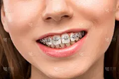 吊带,牙齿,青年女人,自然美,张着嘴,牙科设备,纯净,健康,金属,仅成年人