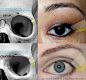 difference of corner of eye in Asian and Caucasian