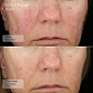 SENTÉ Dermal Repair Cream Before and After Redness after 2 weeks