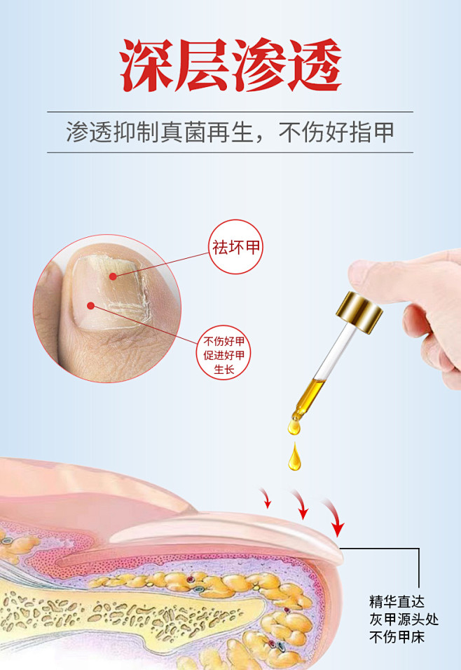 灰指甲专用特效甲沟炎药水抑菌液冰醋酸30...