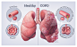 Lungs in health and COPD, medical illustration by Dr Ciléin Kearns (artibiotics)