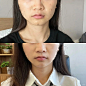 瘦脸针后续 - 小红书