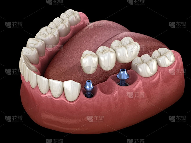 牙桥由种植体支撑。医学上精确的人类牙齿和假牙概念的3D插图素材-花瓣网
