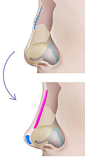 驼峰鼻矫正术#隆鼻##驼峰鼻##矫正3#