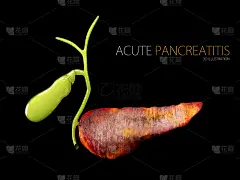 急性胰腺炎3d插图，胰腺炎症在黑色背景