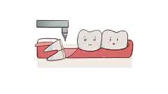 拔智齿  智齿  拔智齿过程  阻生智齿  关于拔智齿  简单智齿拔除  智齿蛀牙  智齿歪斜  侵犯邻牙  无对咬合  萌出时肿胀疼痛  上颌常规智齿  智齿拔除   微创拔智齿  牙龈肿胀  影响邻牙  阻生牙  爱吃歪斜  拔上颌牙智齿  微创拔牙过程  
