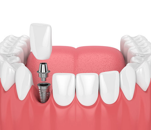 3d呈现器的下巴与牙齿和牙齿门齿种植体图...