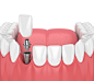3d呈现器的下巴与牙齿和牙齿门齿种植体图片素材-图片ID：317849317
