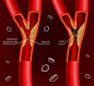 血管里的病变