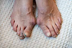 一位上了年纪的妇女的脚趾受到痛风的影响。女性足部易患痛风或关节炎