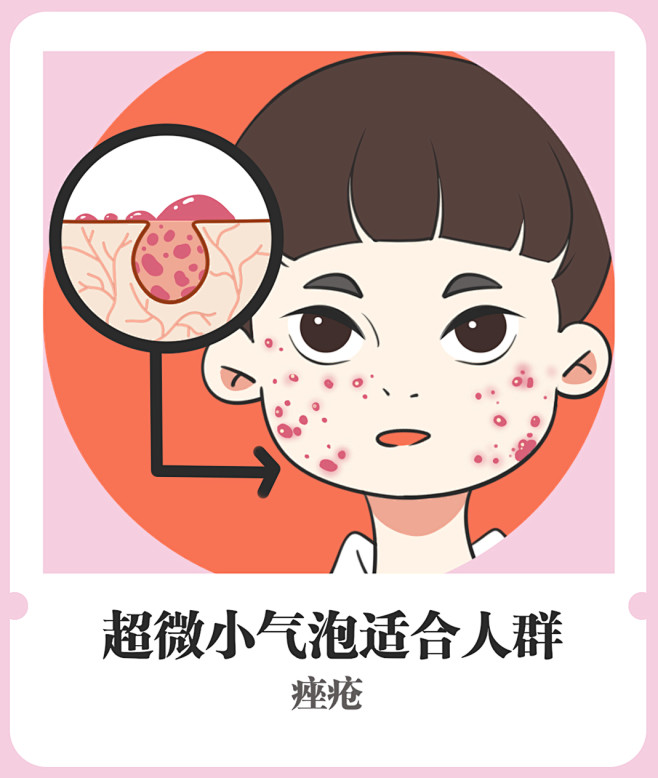 超微小气泡适合人群 毛孔粗大 黑头 白头 肤色暗沉 油光满面 干燥粗糙 粉刺 皮肤松弛 毛孔粗大 痤疮