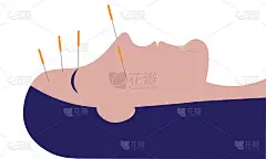 在妇女脸上针灸-偏头痛的替代疗法