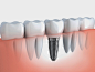dental treatment of dental implant at jamnagar