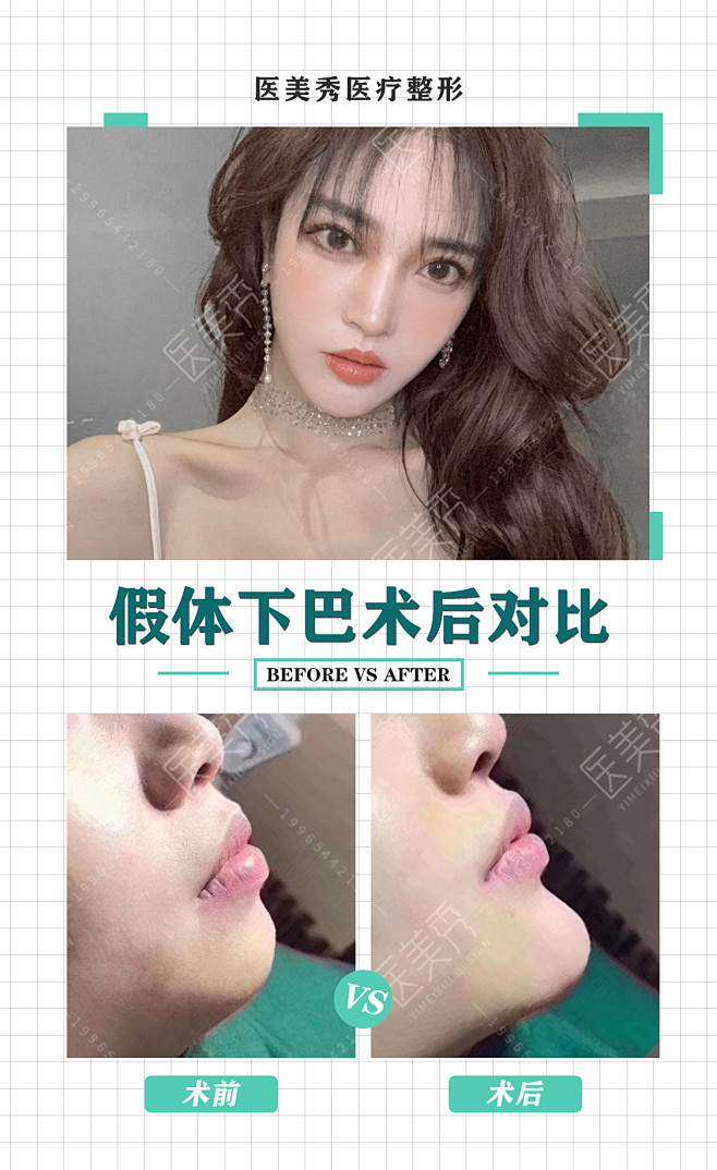 医美对比图下巴