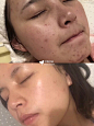 拒绝瑕疵皮，一个痘印不能有！这次先科学认清自己的痘疤再说！_痘痘怎么去_怎么快速去痘痘_小红书
