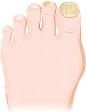 灰指甲