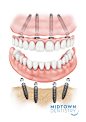 图片：All-on-4 implant Bridge | Teeth in a day | Houston Implant specialist : 在 Google 上搜索到的图片（来源：midtowndentistry.com）