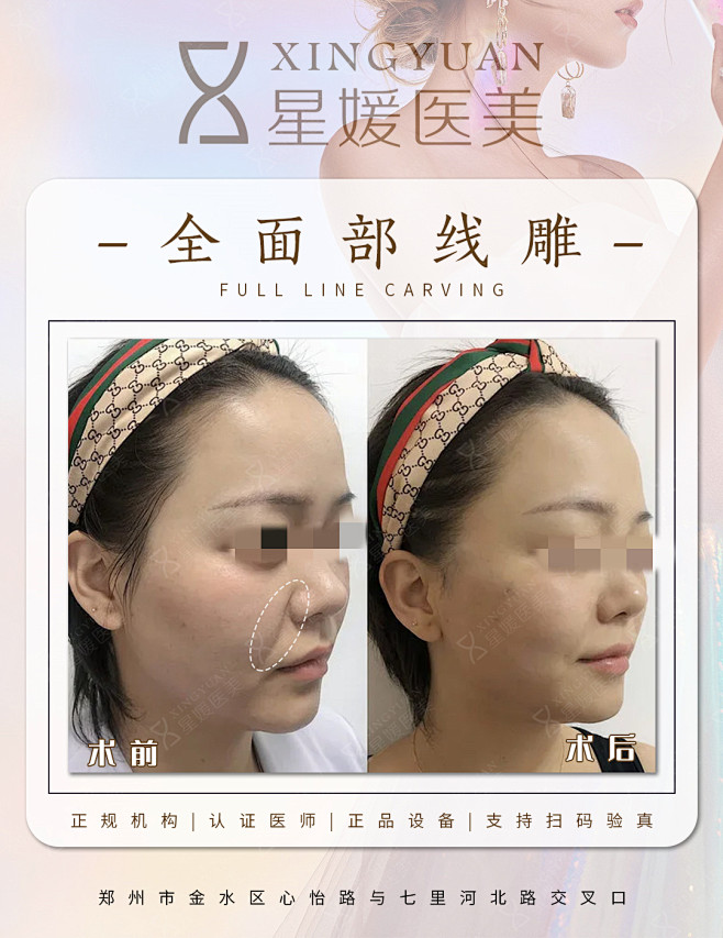 医美效果图对比图前后术后案例效果整形微整医疗美容
