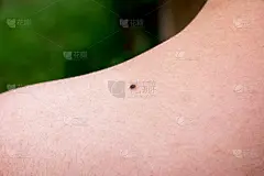 痣,肩,女性,特写,黑色素,雀斑,德国马克符号,黑色素瘤,癌细胞,皮肤病学