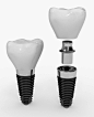 implant, abutment, implant abutment, crown, jamnagar implant, jamnagar dental, jamnagar dentist