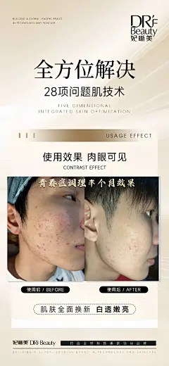 青春痘的危害： 1. 损容：青春痘容易留下疤痕，影响面部美观，影响社交。 2. 心理问题：长青春痘的人可能会产生心理压力，甚至抑郁症。 3. 全身性炎症：严重的痘痘可能会伴随其他全身性炎症，肥胖的人需要特别注意。 看 我家大少如何调理青春期#痘痘肌 #如何拯救痘痘肌 #痘坑痘印 #痘印 #疤痕 - 小红书