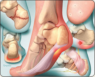 Heel Pain: Diagnosis...