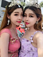 【术后第3天】双胞胎姐姐最新恢复照！火速围观！