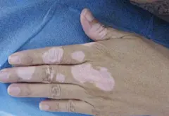 白癜风 症状的搜索结果_360图片