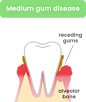Medium gum disease