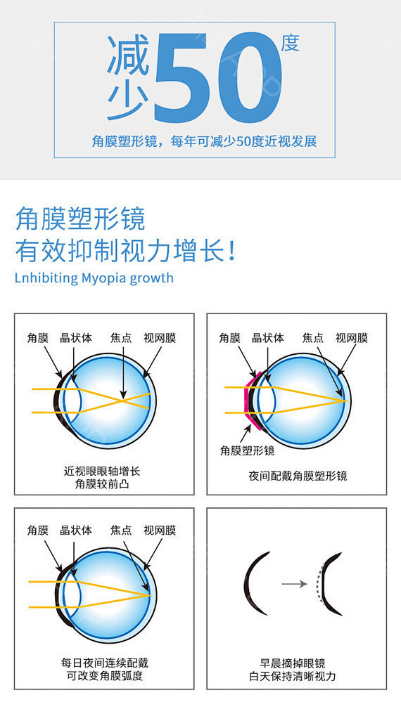 【OK镜近视矫正】OK镜【近视矫正】角膜塑形镜（ok镜）白天戴，晚上摘，还你清晰视界-新氧美容整形