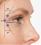 Botox Injection Sites