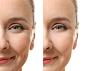 Medical-Spa-Hamptons-Fat-Reduction-Skin-Tightening-Laser-Skin-Treatments-Rejuvalift-583486396