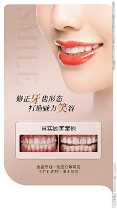 口腔牙瓷贴面