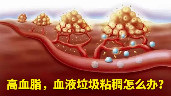 高血脂