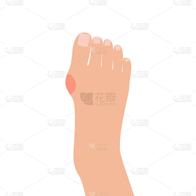 拇外翻是人类腿部骨骼的足外翻畸形，拇囊炎。类风湿性关节炎关节体。关节、足趾部位红痛。医学概念。矢量图素材-花瓣网
