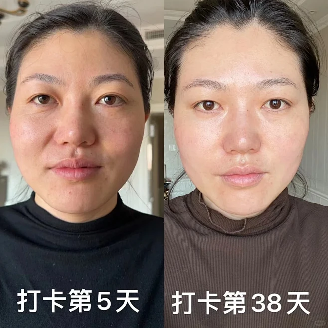 苏月何曾饶过谁 唯有抗衰有底气#衰老逆龄去皱纹#前后对比#全脸提升 - 小红书-花瓣网