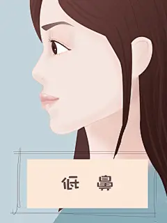 低鼻
鼻子鼻头鼻梁
医疗美容整形插画 卡通手绘漫画 可爱女孩美女 脸部面部症状系列