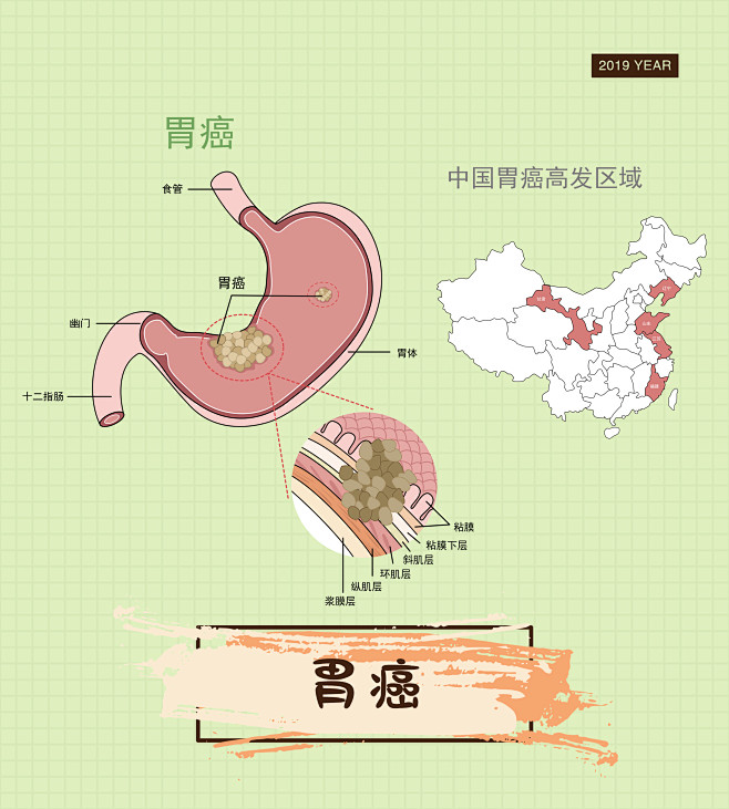 胃癌人体消化系统肿瘤癌症细胞疾病症状医疗人体系统人体解剖人体器官