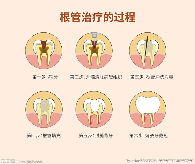 根管治疗插画
