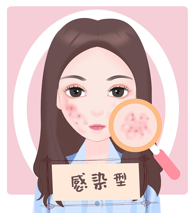 感染型脸部面部痤疮痘痘青春痘
医疗美容整...
